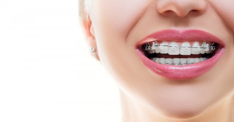 Keramische beugels - Orthodontist Amsterdam braces of voor jong en oud